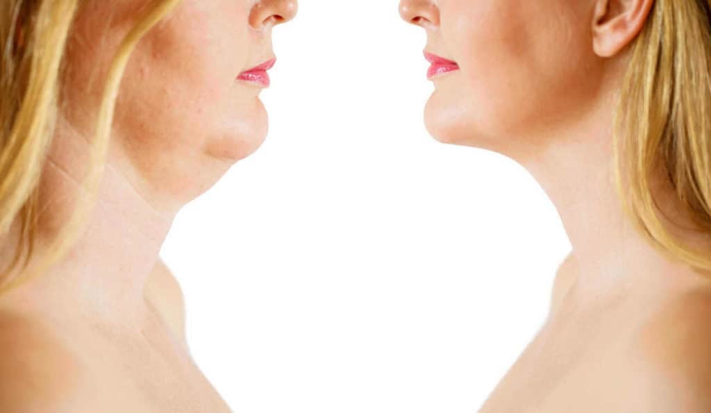 Double Chin treatment Greater London (Kingston upon Thames) before and after results