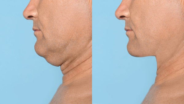 Which Non-Surgical Treatments Work Best for Jowls and Loose Skin Greater London (Kingston upon Thames)?