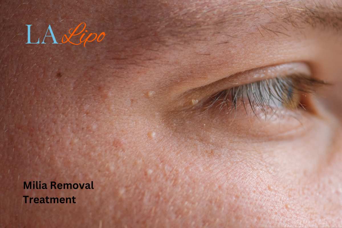 Cryopen Milia Removal: Is It the Easiest and Safest Option Greater London (Kingston upon Thames)?