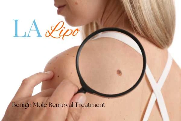 Woman having her inspection of blemish before mole removal Greater London (Kingston upon Thames)