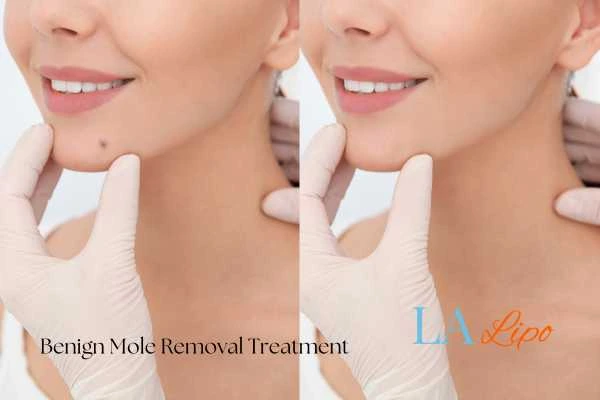 woman's before and after mole removal Greater London (Kingston upon Thames) results