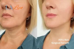 hi-fu for wrinkles Greater London (Kingston upon Thames) before and after results