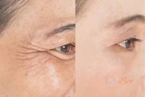 Before and after results of woman - HI-fu wrinkles reduction treatment Greater London (Kingston upon Thames)