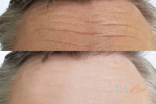 results of HIFU Greater London (Kingston upon Thames) on mans forehead to help reduce lines and wrinkles