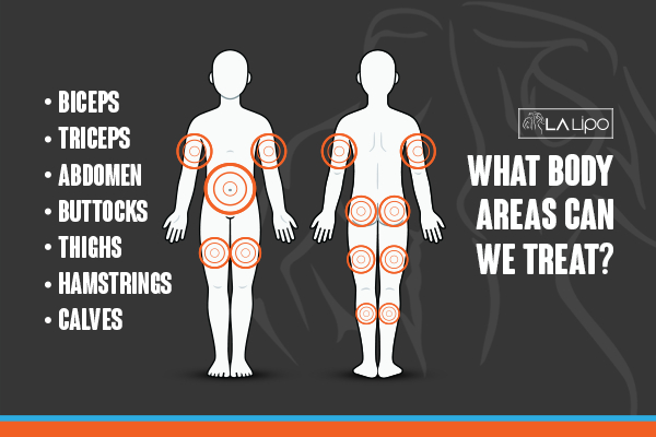 Graphic to show areas you can have LA-EMS Body Sculpting Greater London (Kingston upon Thames) treatment.