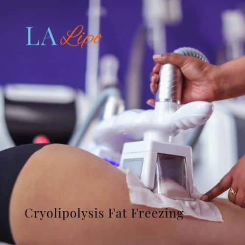 fat freezing - Cryolipolysis Greater London (Kingston upon Thames)