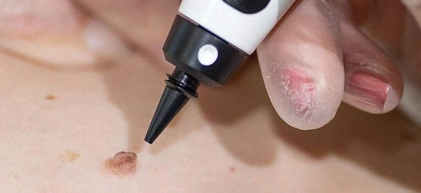 skin tag removal using cryopen Greater London (Kingston upon Thames)