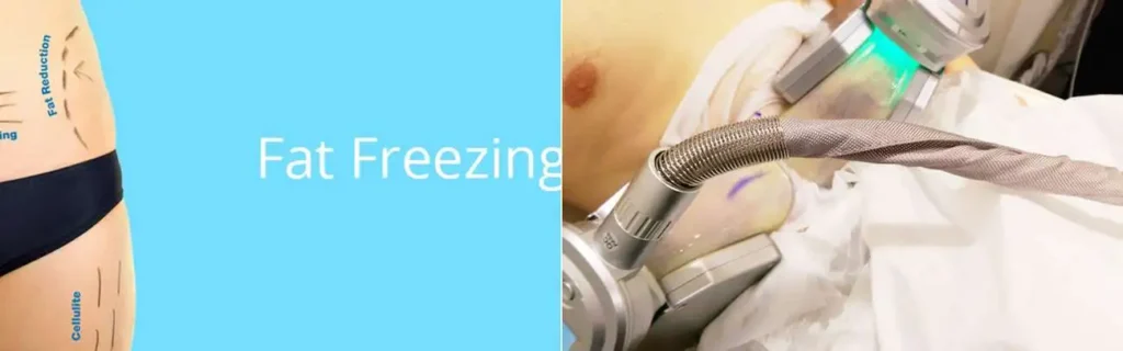 multi areas of a persons body having coolsculpting Greater London (Kingston upon Thames) treatment