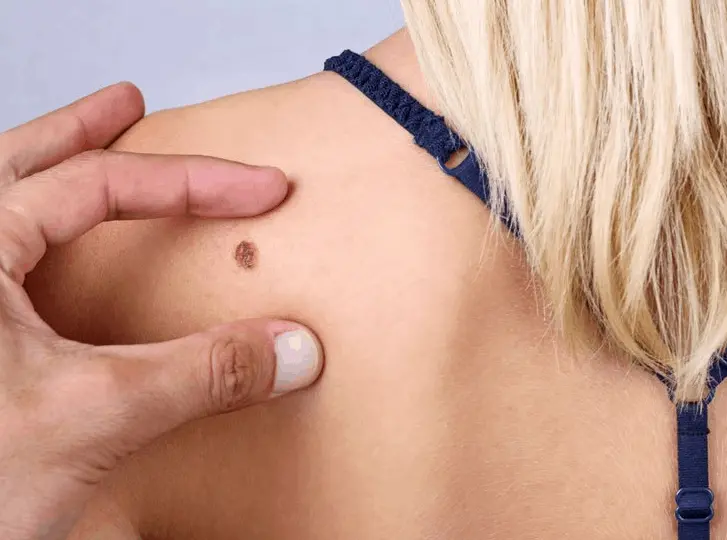 woman having mole removal Greater London (Kingston upon Thames) consultation before treatment.