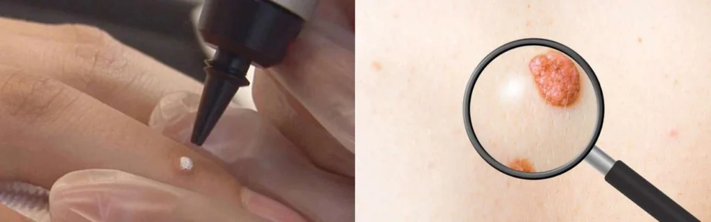 Person getting moles removed with cryopen Greater London (Kingston upon Thames)