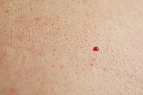 close up of a cherry angioma Greater London (Kingston upon Thames)