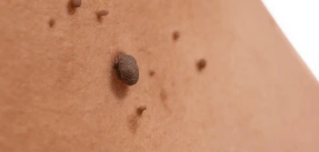 image of a skin tag Greater London (Kingston upon Thames)