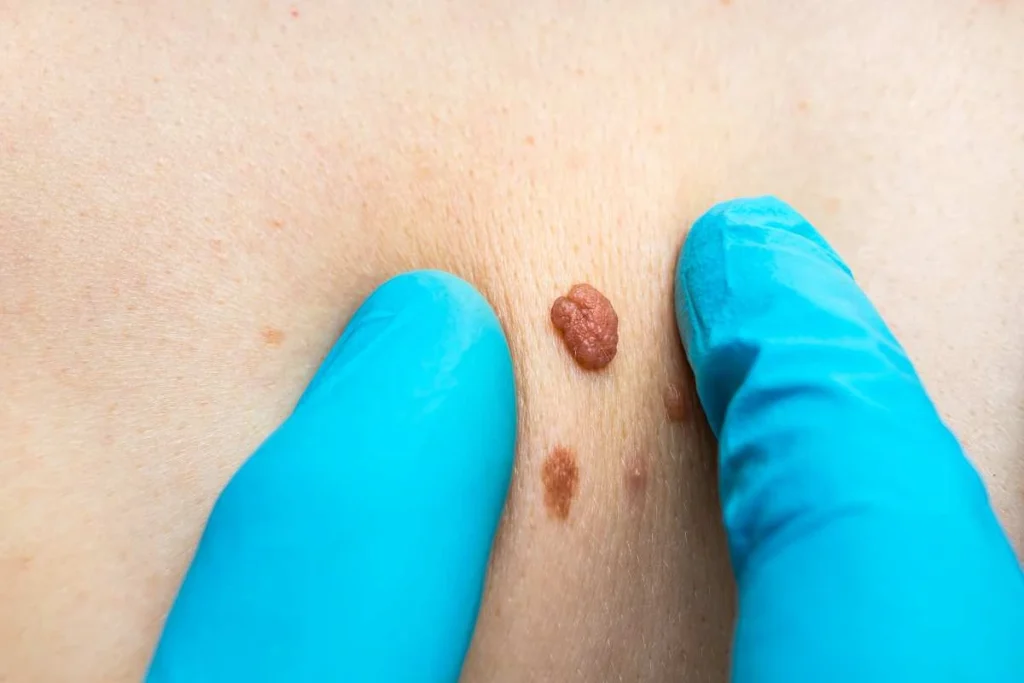 Consultant examining a skin tag Greater London (Kingston upon Thames)
