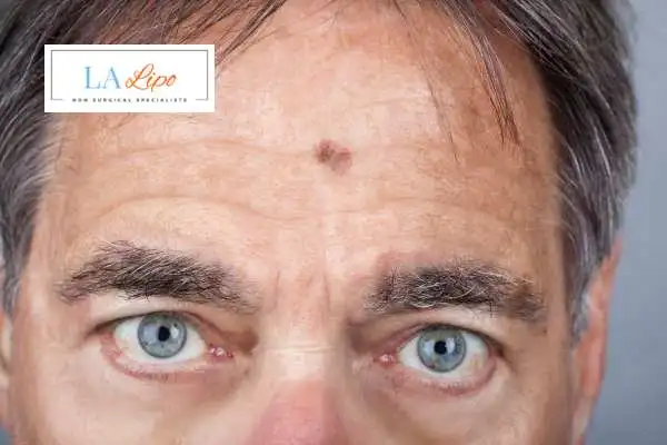 Solar Lentigo Removal Greater London (Kingston upon Thames) image of man with mark on his forehead