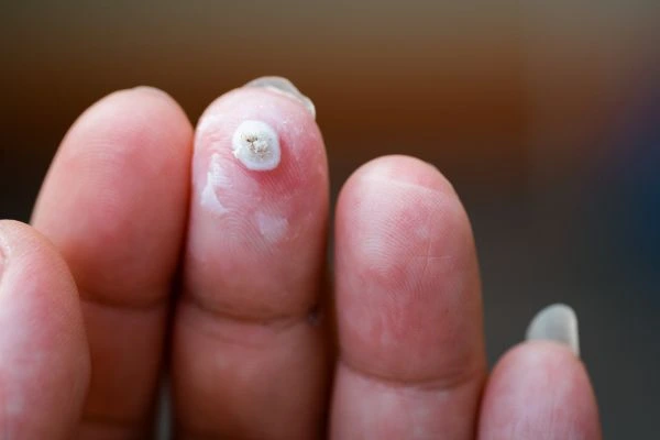 wart on person finger - cryotherapy to treat from LA LIPO Greater London (Kingston upon Thames)