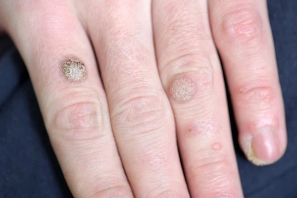 photo of warts on person hand - see wart removal Greater London (Kingston upon Thames) from LA LIPO