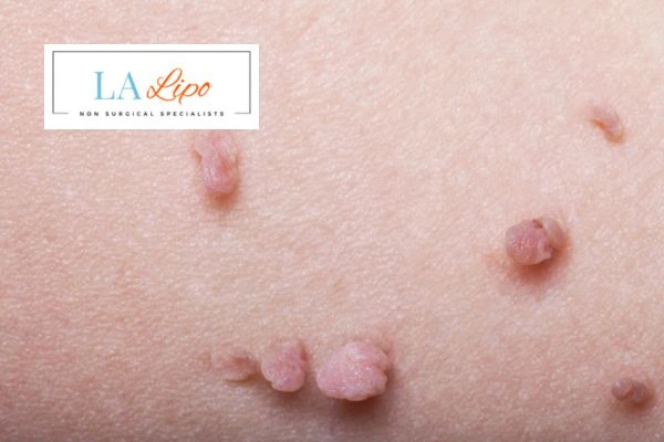 Does cryopen skin tag removal Greater London (Kingston upon Thames) hurt? Find out now call our team today!