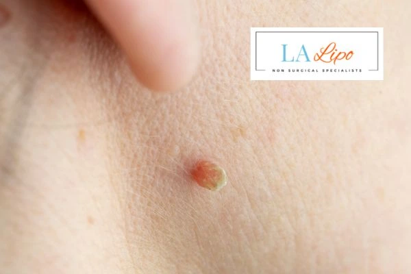 Book skin tag removal Greater London (Kingston upon Thames) today speak to our team now!