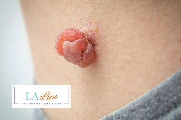 Interested in skin tag removal Greater London (Kingston upon Thames)? Concerned about the pain? Find out more today!