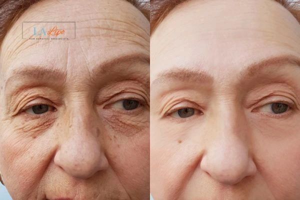 The powerful benefits of Morpheus8 Treatment Greater London (Kingston upon Thames) - Call Our team today!