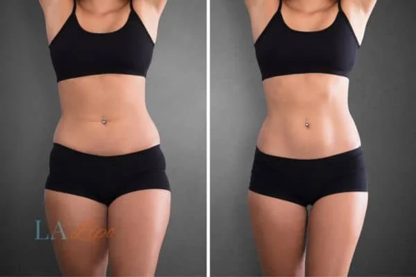 before and after results of non-surgical treatment to help a woman's body image and mental health Greater London (Kingston upon Thames)