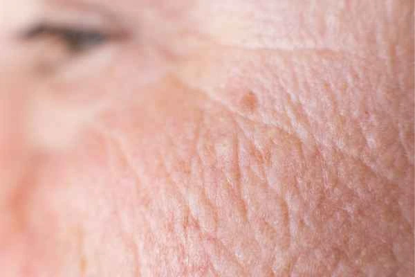 close up picture of a woman's face showing an age spot Greater London (Kingston upon Thames)