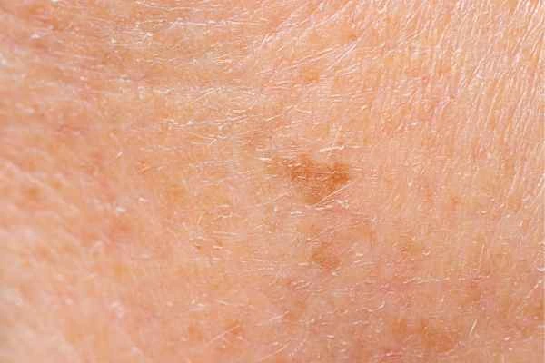 close up picture of age spots Greater London (Kingston upon Thames)