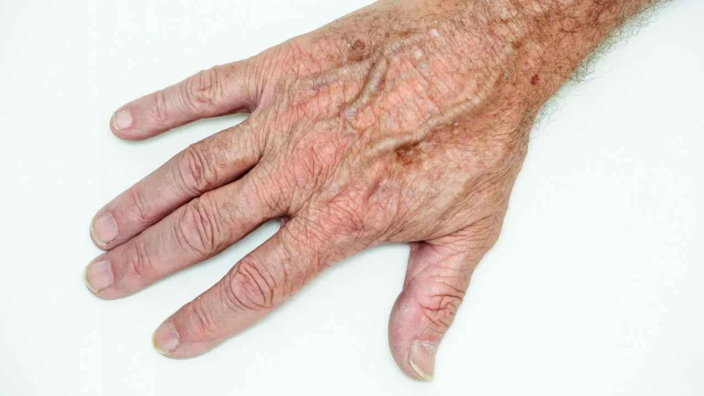 Male hand showing age spot Greater London (Kingston upon Thames)