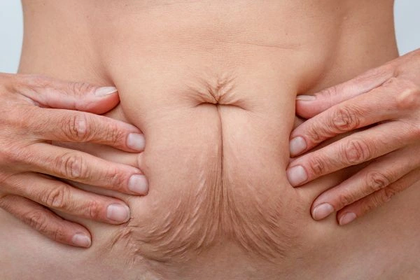 Image of a woman's stomach with loose skin - example of skin tightening Greater London (Kingston upon Thames) options