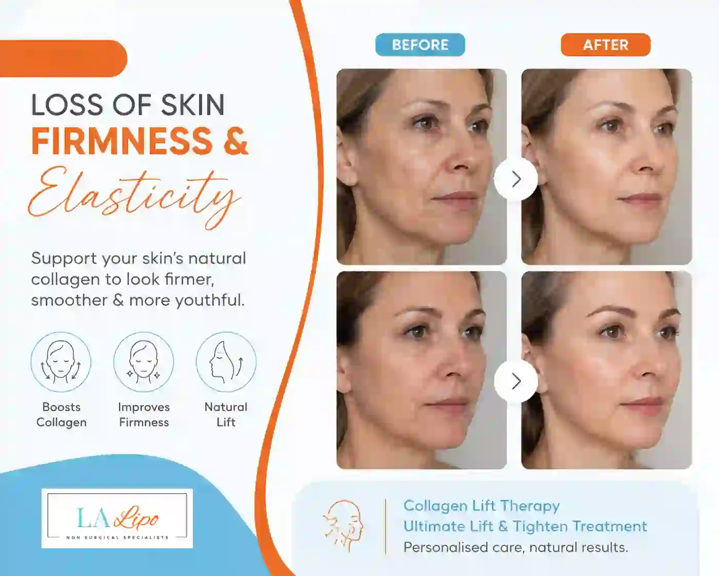 Sign #7: Loss of Skin Firmness and Elasticity Greater London (Kingston upon Thames)